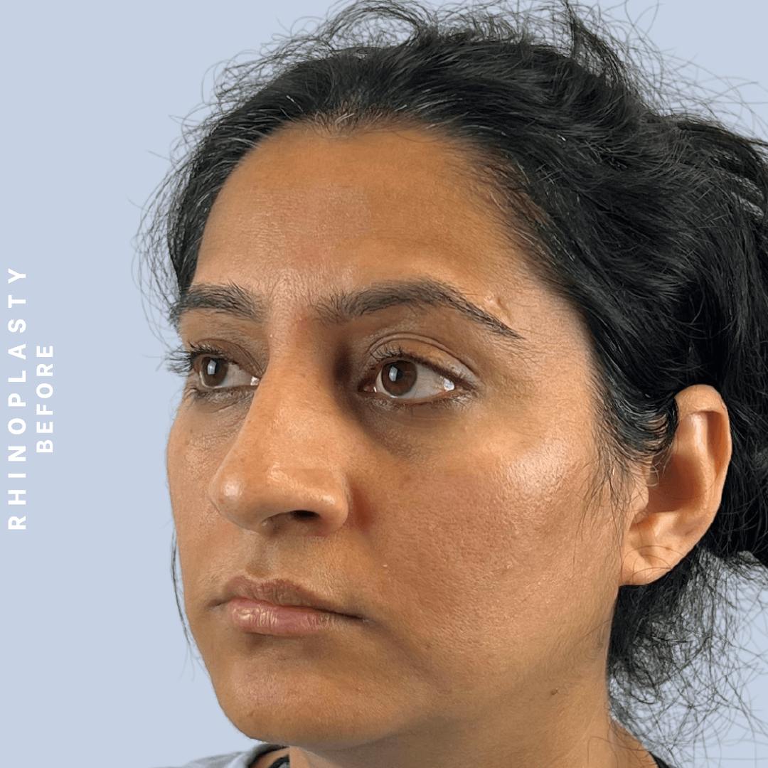 Nose Before & After Gallery - Patient 310117 - Image 5