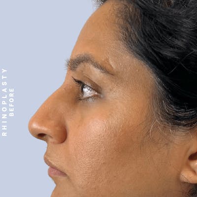 Nose Before & After Gallery - Patient 310117 - Image 1
