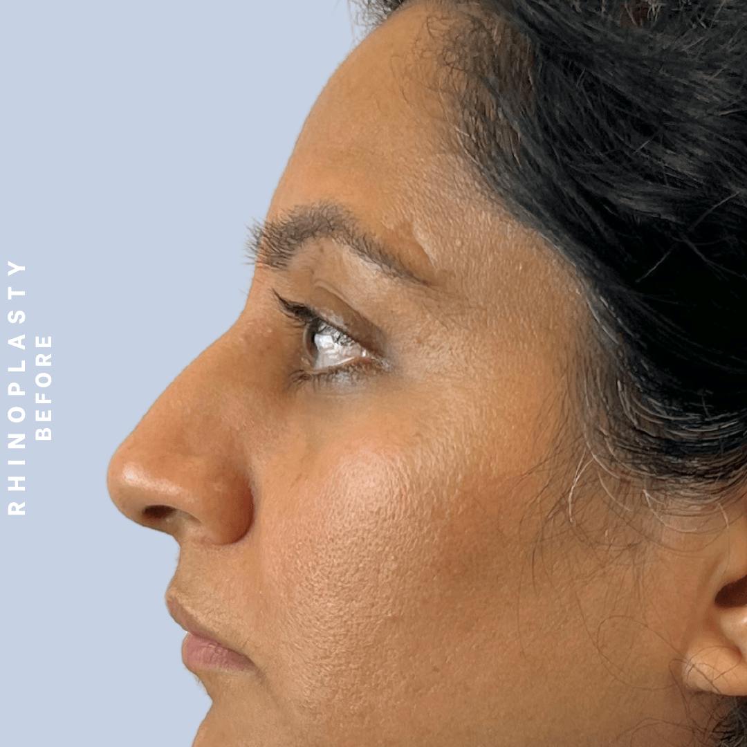 Nose Before & After Gallery - Patient 310117 - Image 1