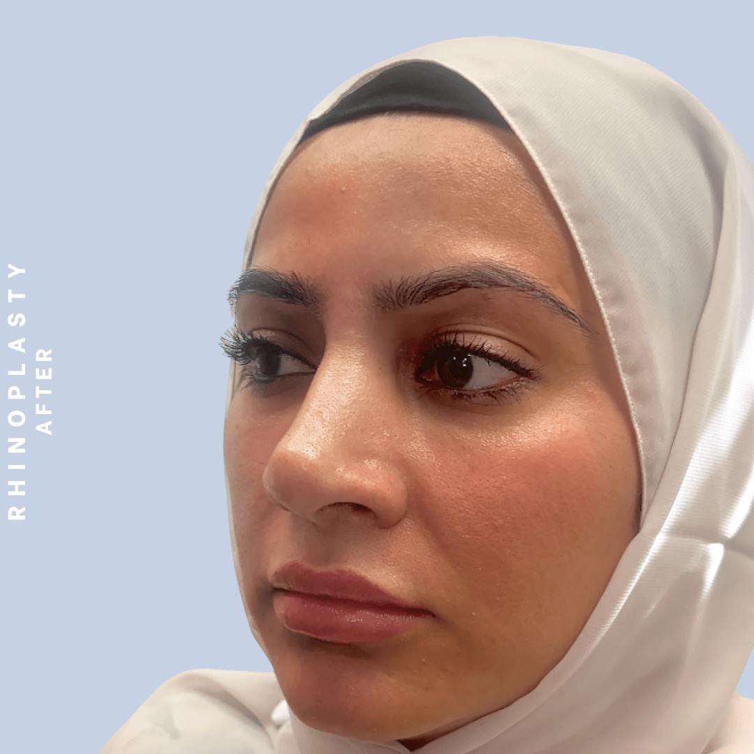 Nose Before & After Gallery - Patient 310117 - Image 6