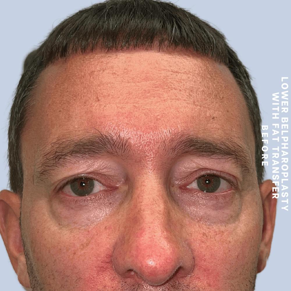 Eyes Before & After Gallery - Patient 361454 - Image 1