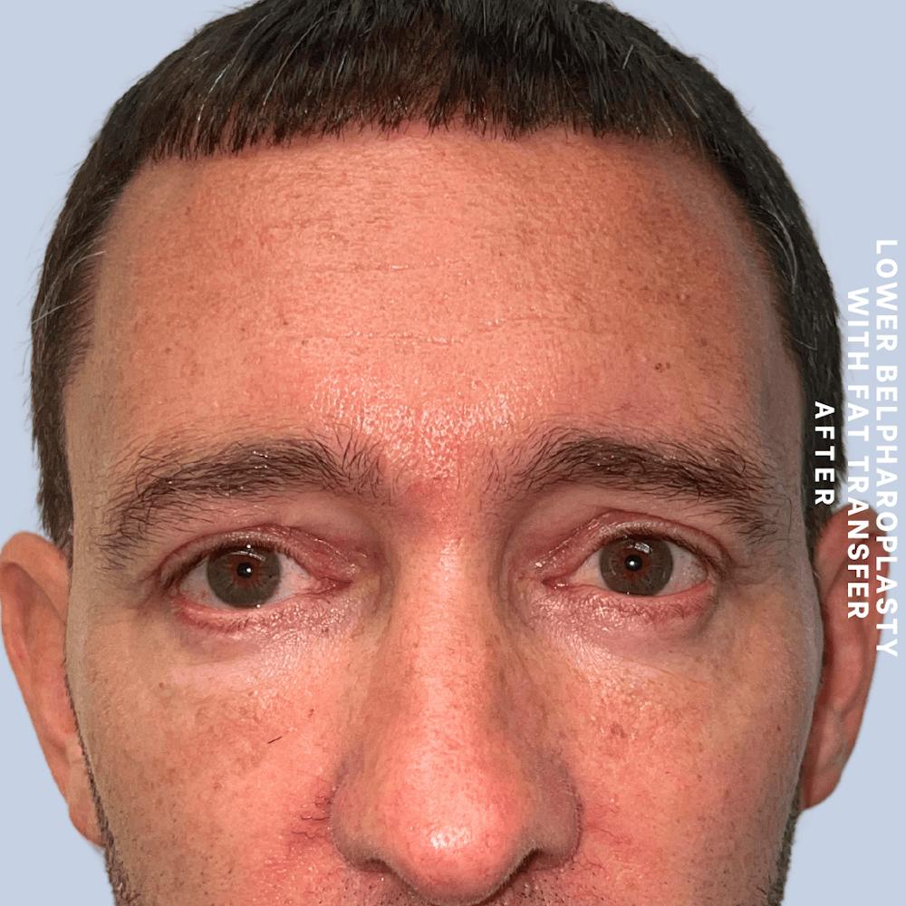 Eyes Before & After Gallery - Patient 361454 - Image 2