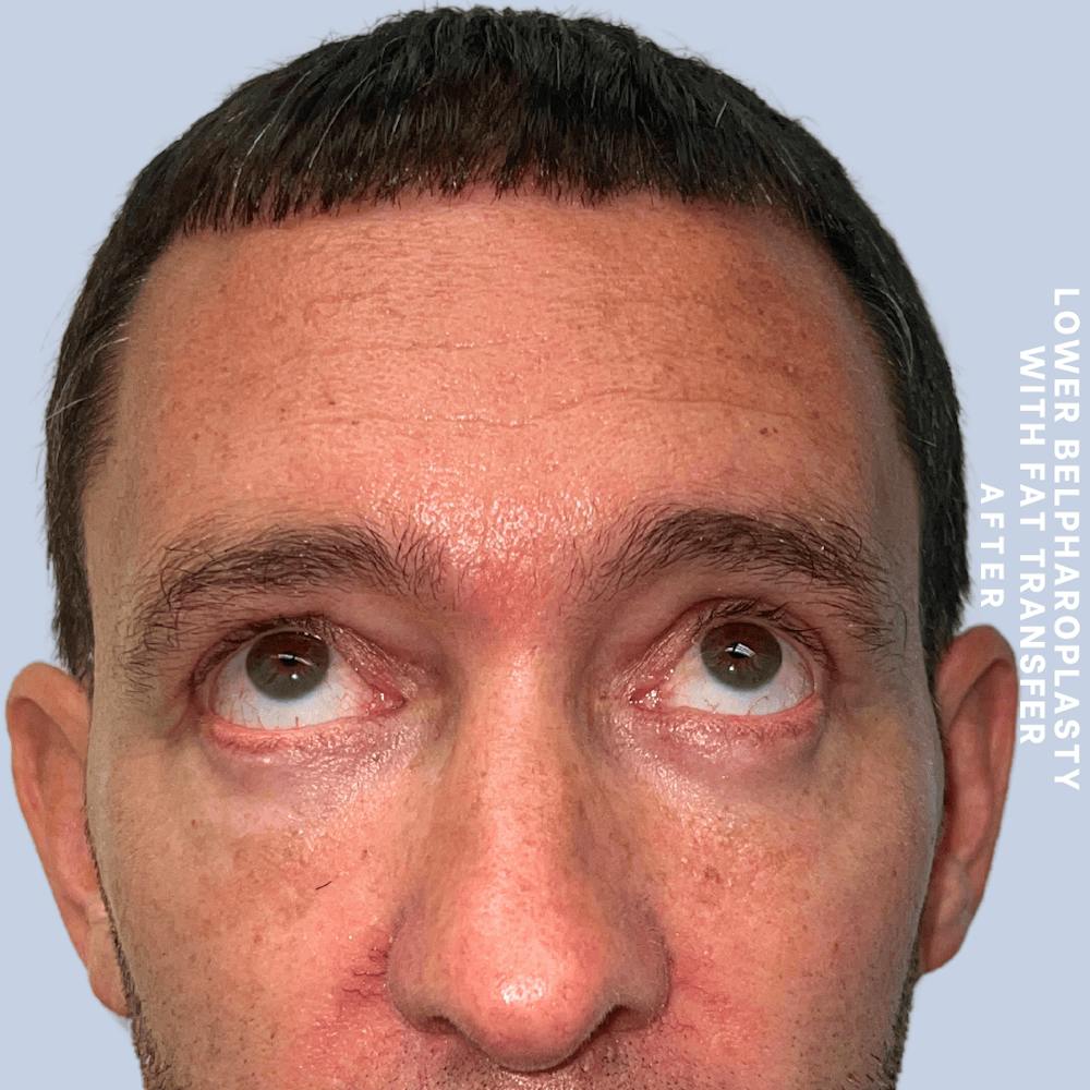 Eyes Before & After Gallery - Patient 361454 - Image 4