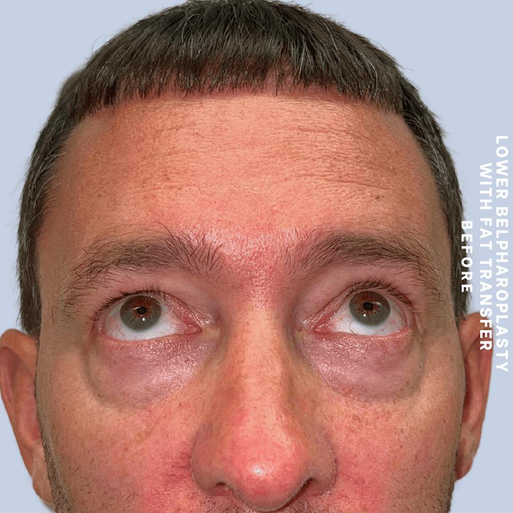 Eyes Before & After Gallery - Patient 361454 - Image 3