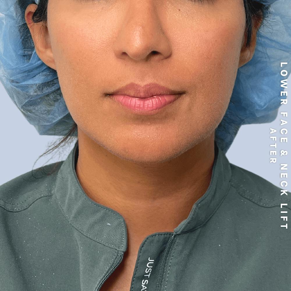 Face & Neck Before & After Gallery - Patient 393993 - Image 2