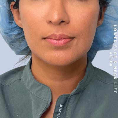 Face & Neck Before & After Gallery - Patient 393993 - Image 2