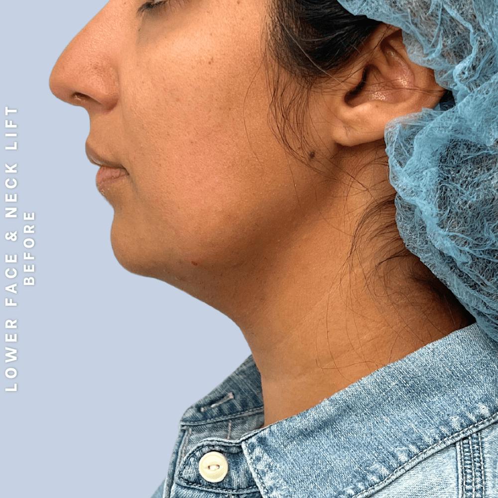 Face & Neck Before & After Gallery - Patient 393993 - Image 5