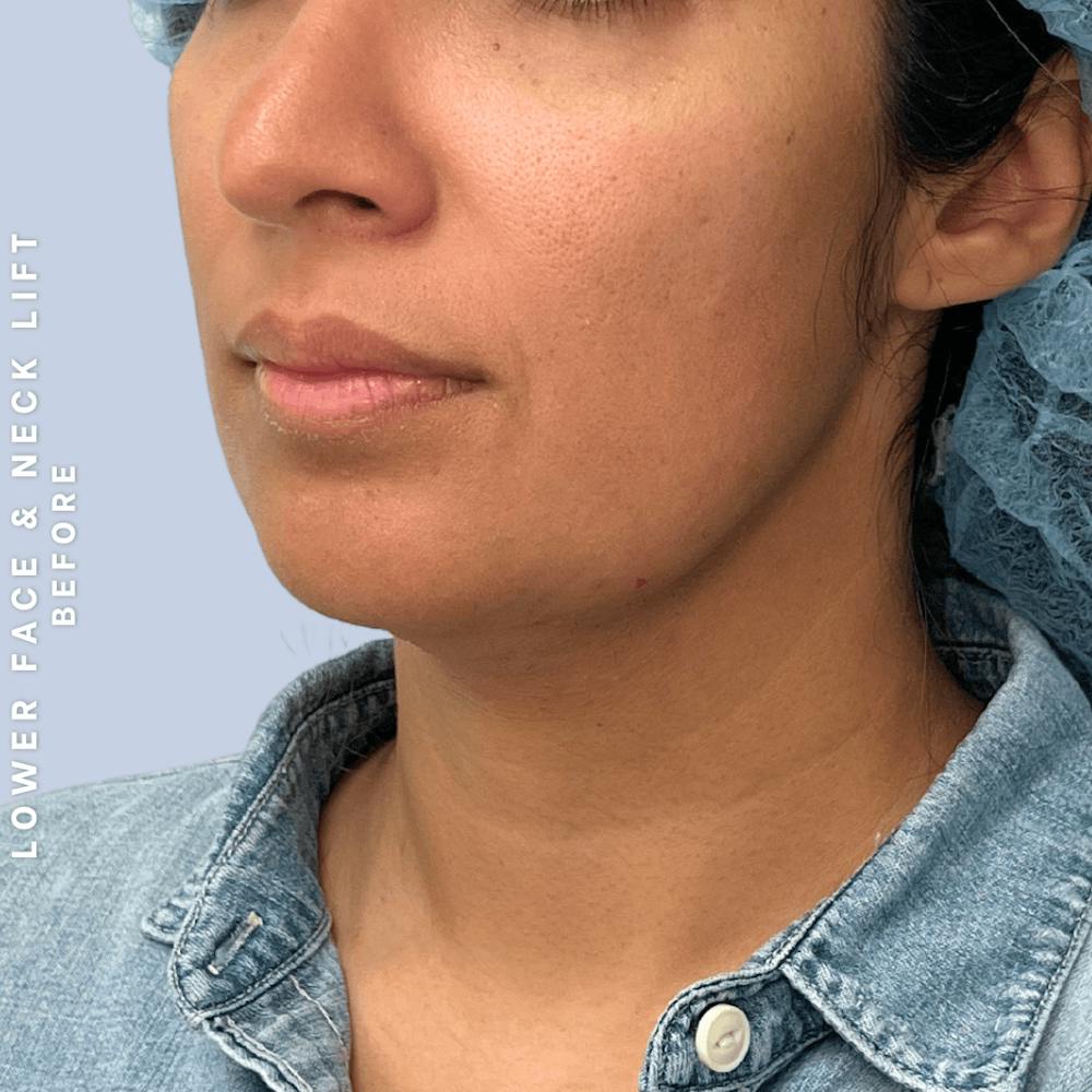 Face & Neck Before & After Gallery - Patient 393993 - Image 7