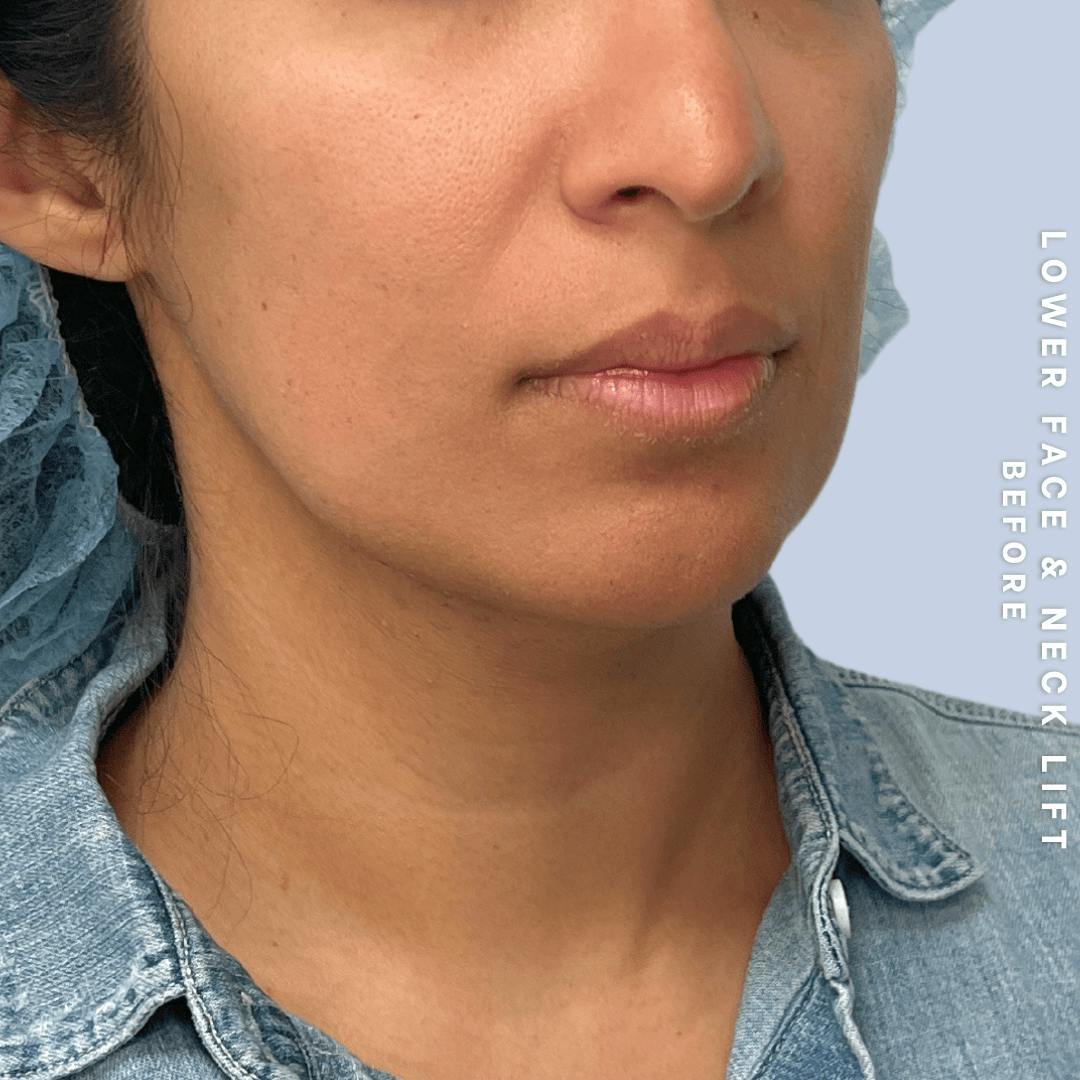 Face & Neck Before & After Gallery - Patient 393993 - Image 9