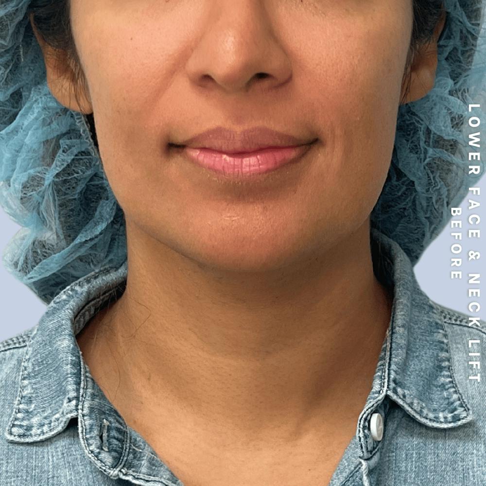 Face & Neck Before & After Gallery - Patient 393993 - Image 1
