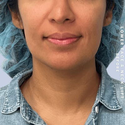 Face & Neck Before & After Gallery - Patient 393993 - Image 1