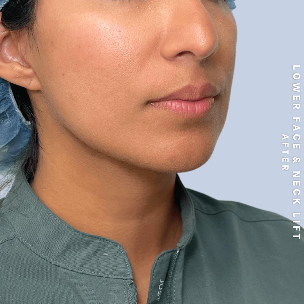 Face & Neck Before & After Gallery - Patient 393993 - Image 10