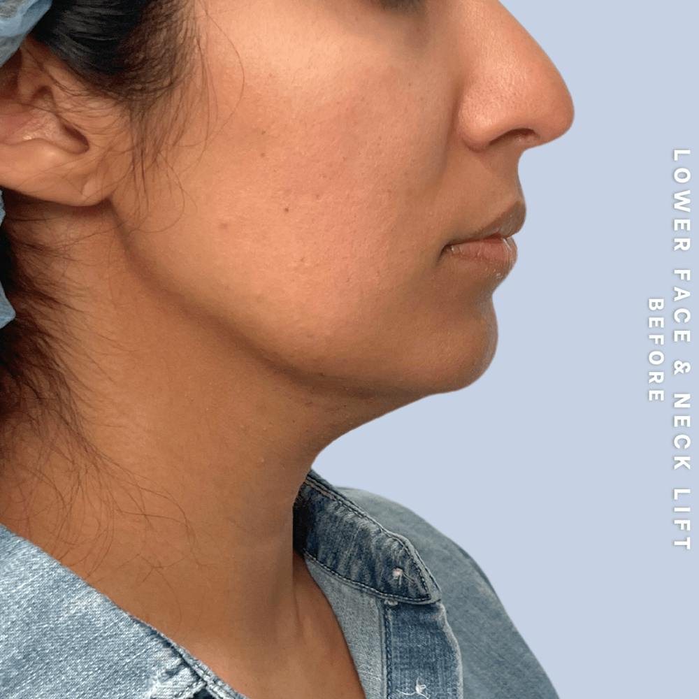 Face & Neck Before & After Gallery - Patient 393993 - Image 3