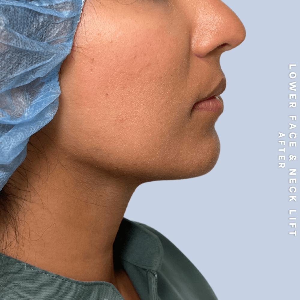 Face & Neck Before & After Gallery - Patient 393993 - Image 4
