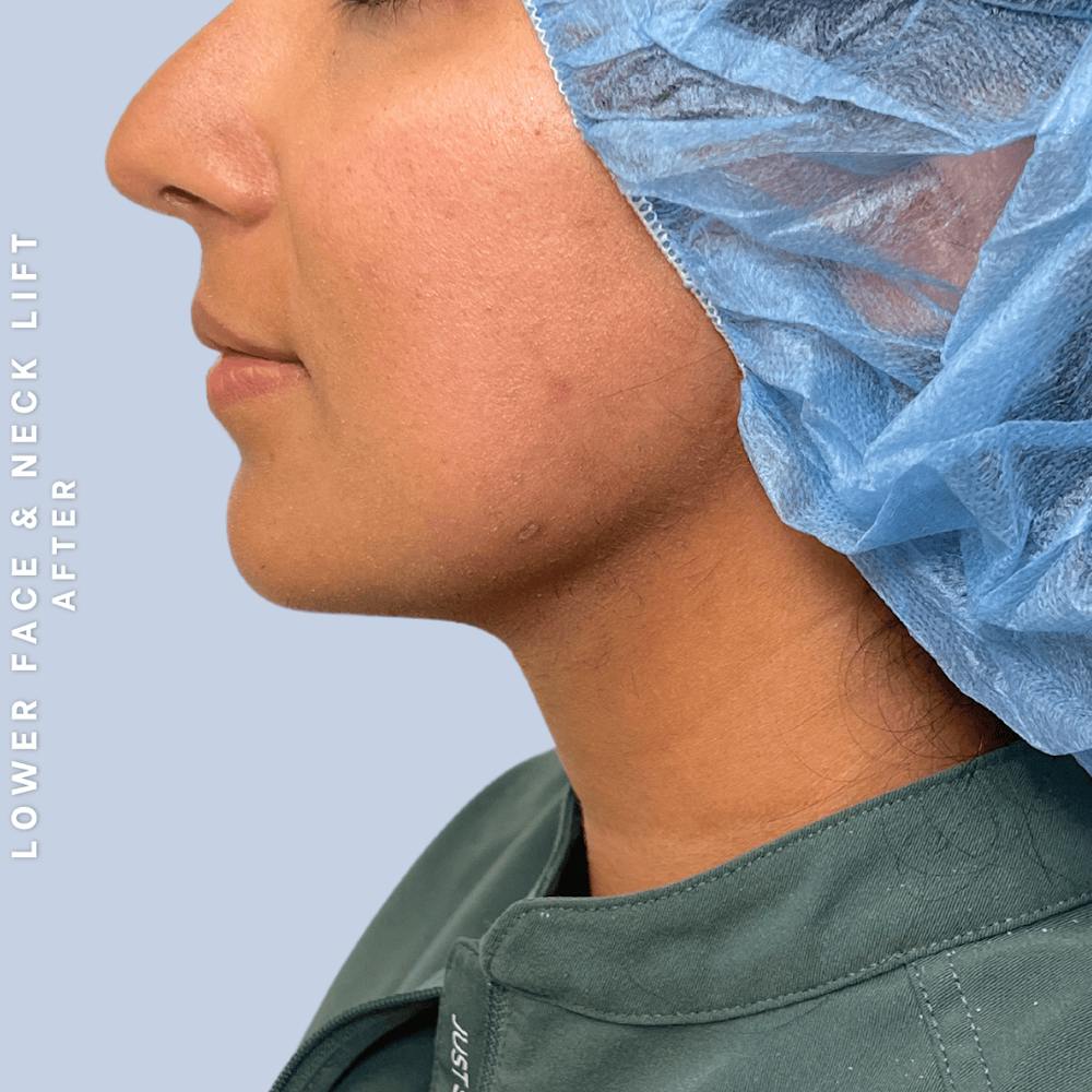 Face & Neck Before & After Gallery - Patient 393993 - Image 6