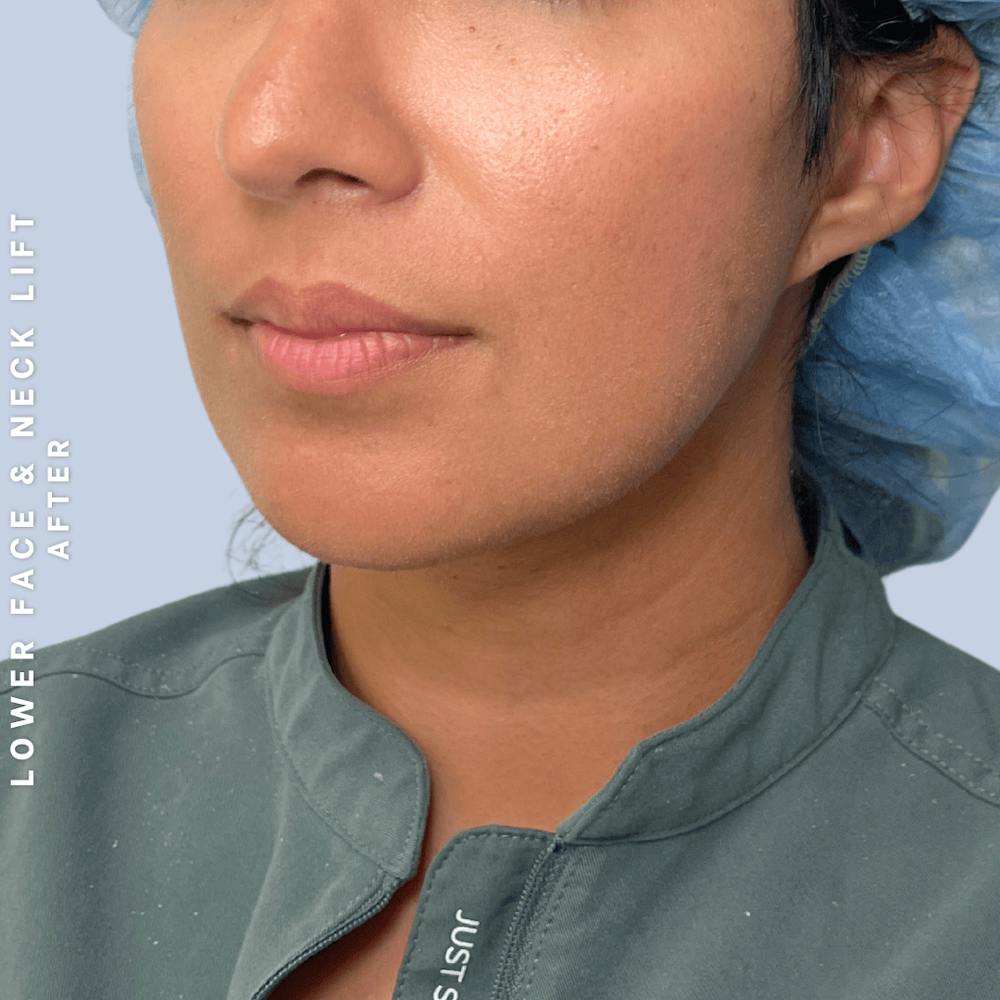 Face & Neck Before & After Gallery - Patient 393993 - Image 8