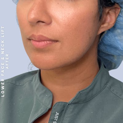 Face & Neck Before & After Gallery - Patient 393993 - Image 8