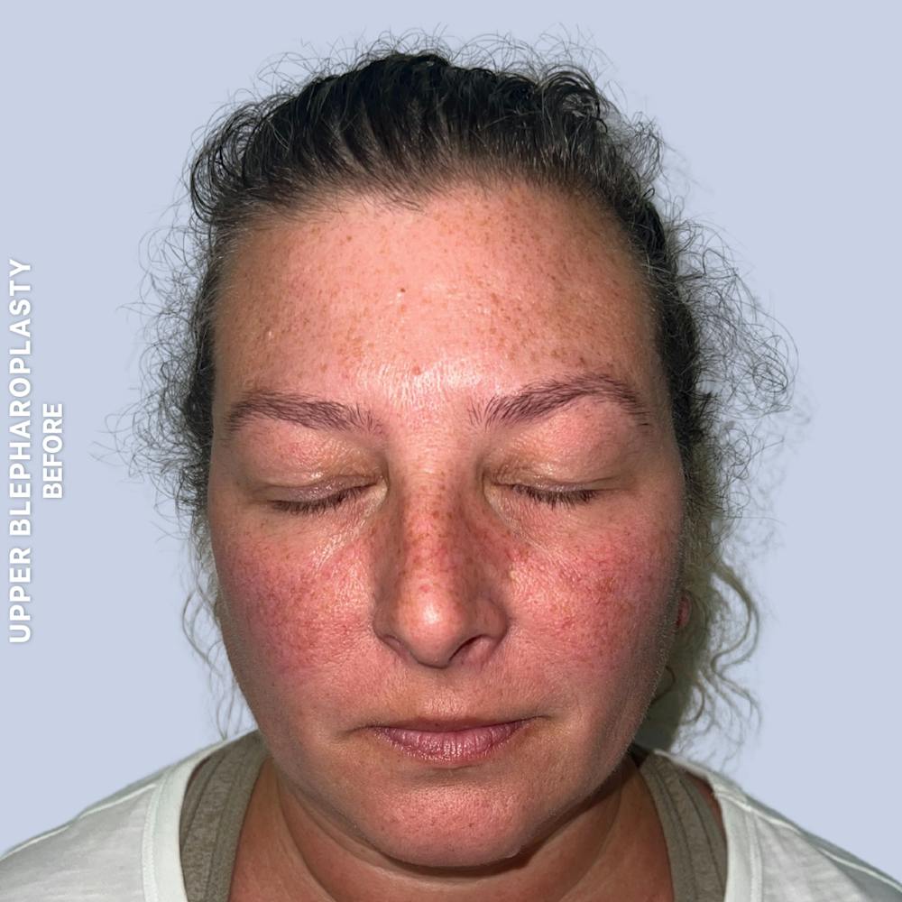 Eyes Before & After Gallery - Patient 410512 - Image 1