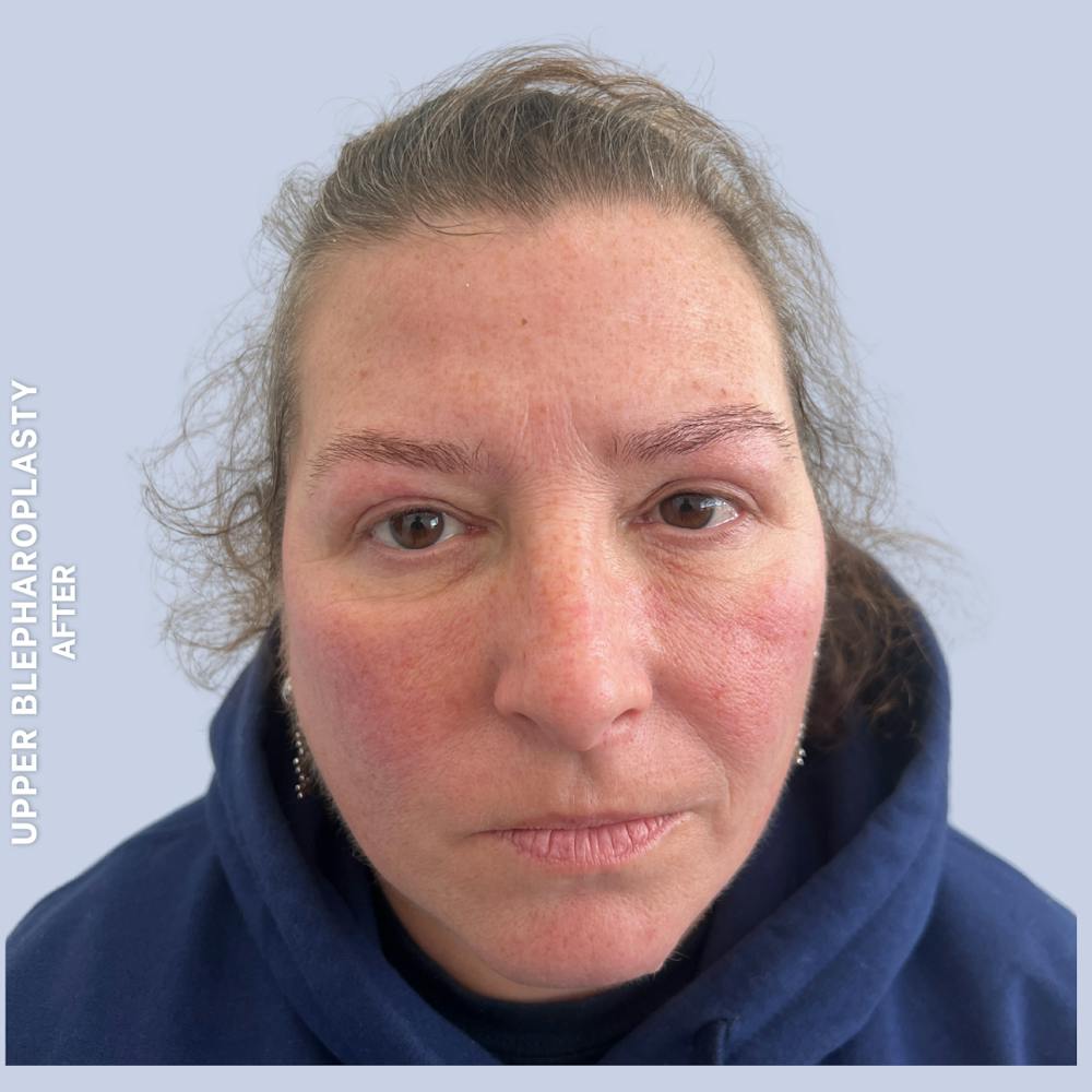 Eyes Before & After Gallery - Patient 410512 - Image 2
