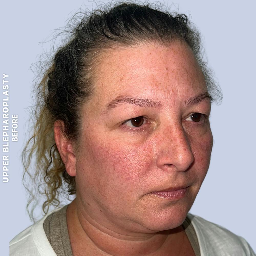 Eyes Before & After Gallery - Patient 410512 - Image 3