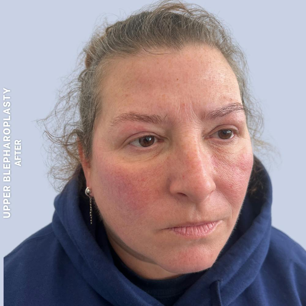 Eyes Before & After Gallery - Patient 410512 - Image 4