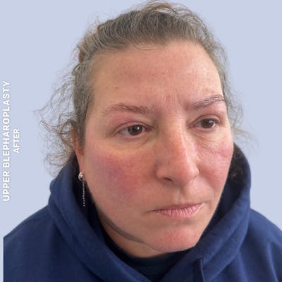 Eyes Before & After Gallery - Patient 410512 - Image 4