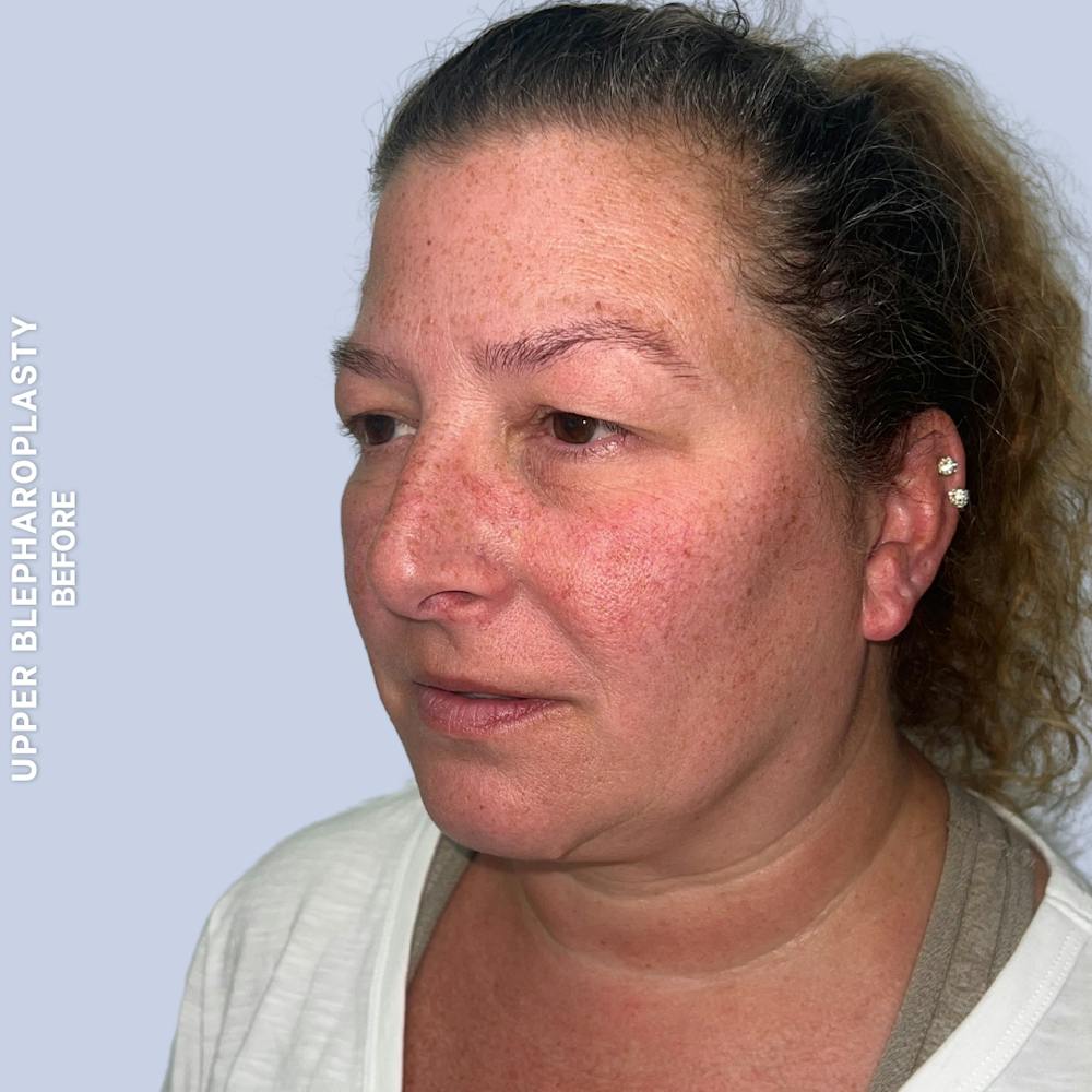 Eyes Before & After Gallery - Patient 410512 - Image 5