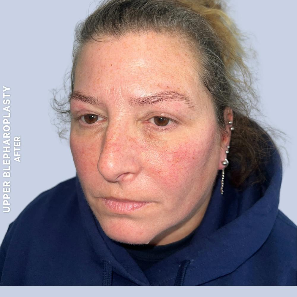 Eyes Before & After Gallery - Patient 410512 - Image 6