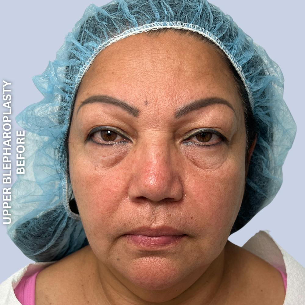 Eyes Before & After Gallery - Patient 205251 - Image 1