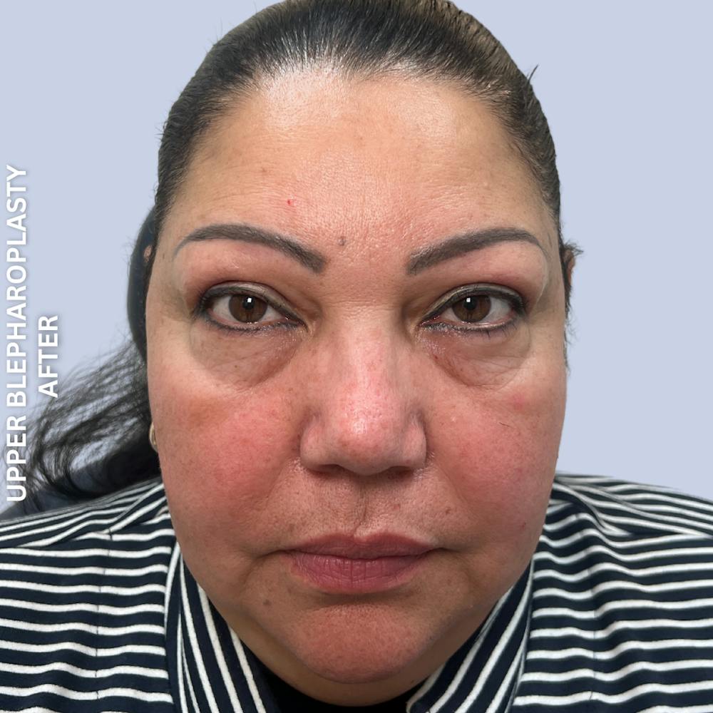 Eyes Before & After Gallery - Patient 205251 - Image 2
