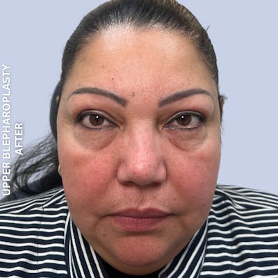 Eyes Before & After Gallery - Patient 205251 - Image 2