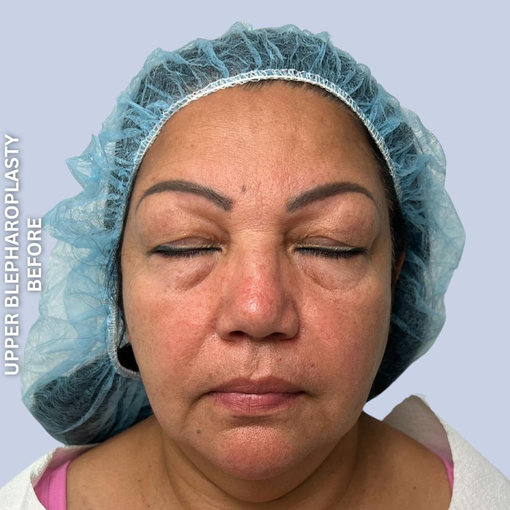 Eyes Before & After Gallery - Patient 205251 - Image 3
