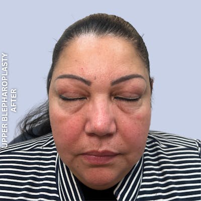 Eyes Before & After Gallery - Patient 205251 - Image 4