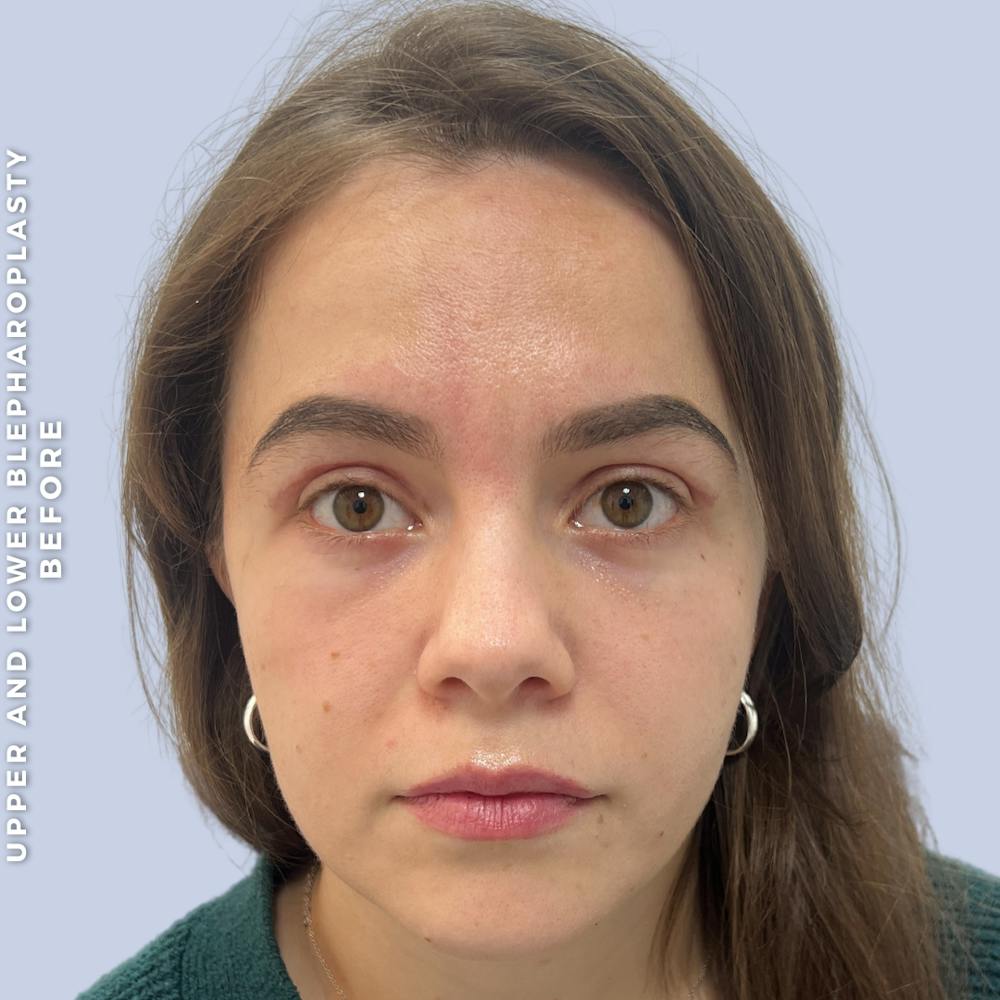 Eyes Before & After Gallery - Patient 368787 - Image 2