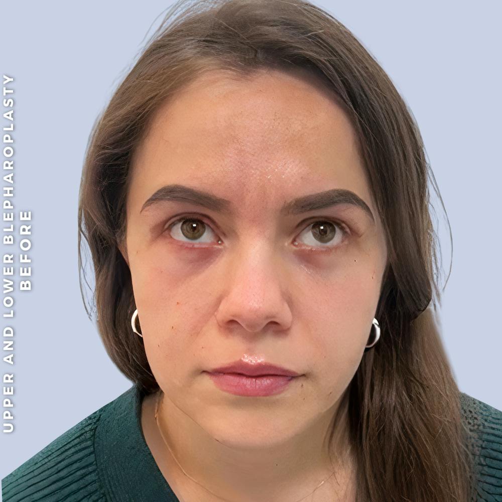 Eyes Before & After Gallery - Patient 368787 - Image 4