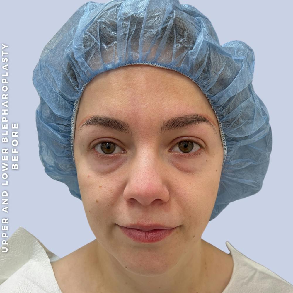 Eyes Before & After Gallery - Patient 368787 - Image 1