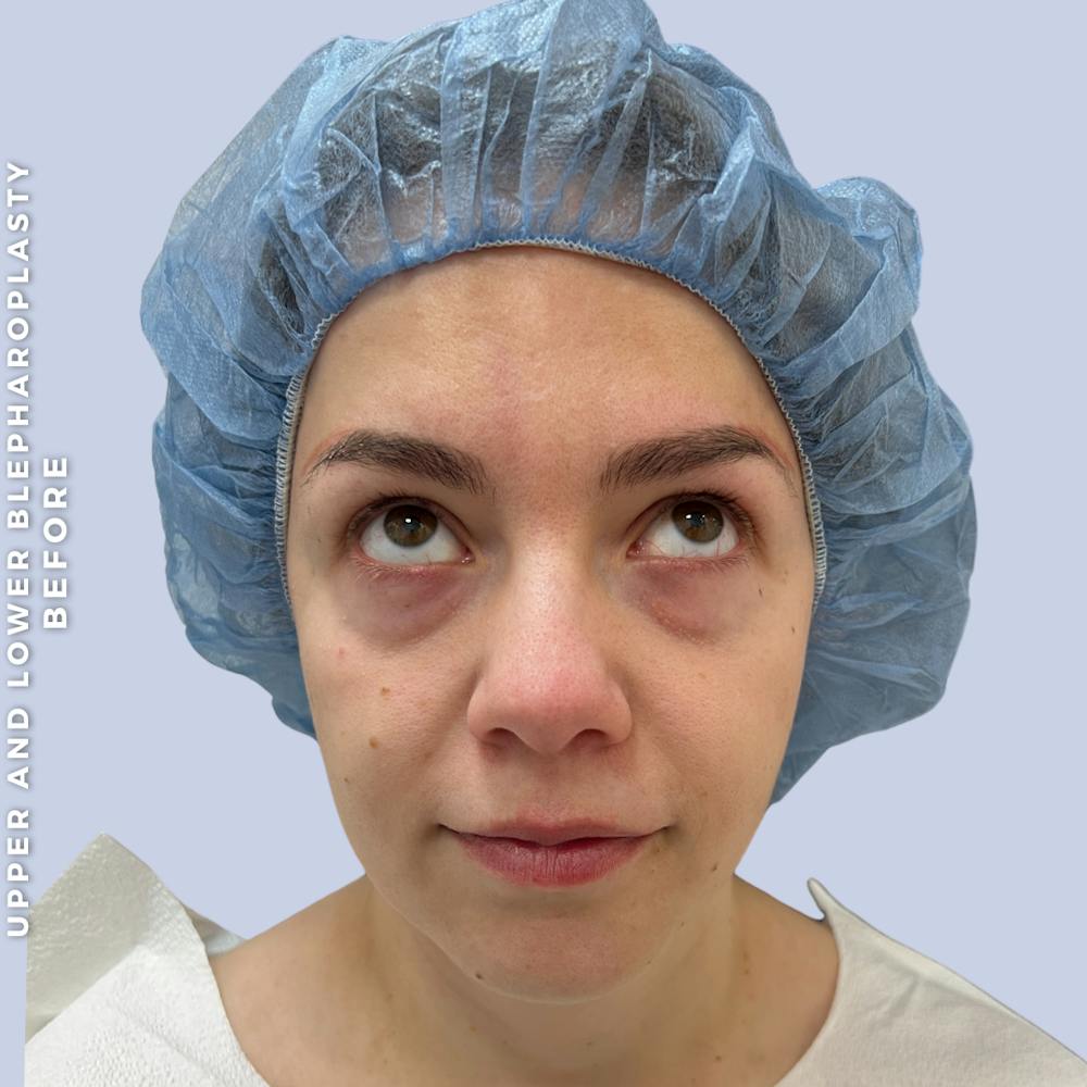 Eyes Before & After Gallery - Patient 368787 - Image 3