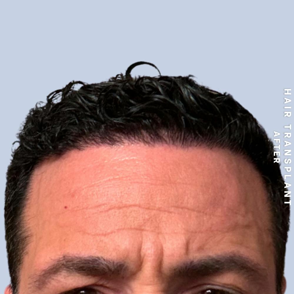 Men's Hair Before & After Gallery - Patient 174166 - Image 4
