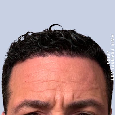 Men's Hair Before & After Gallery - Patient 174166 - Image 4