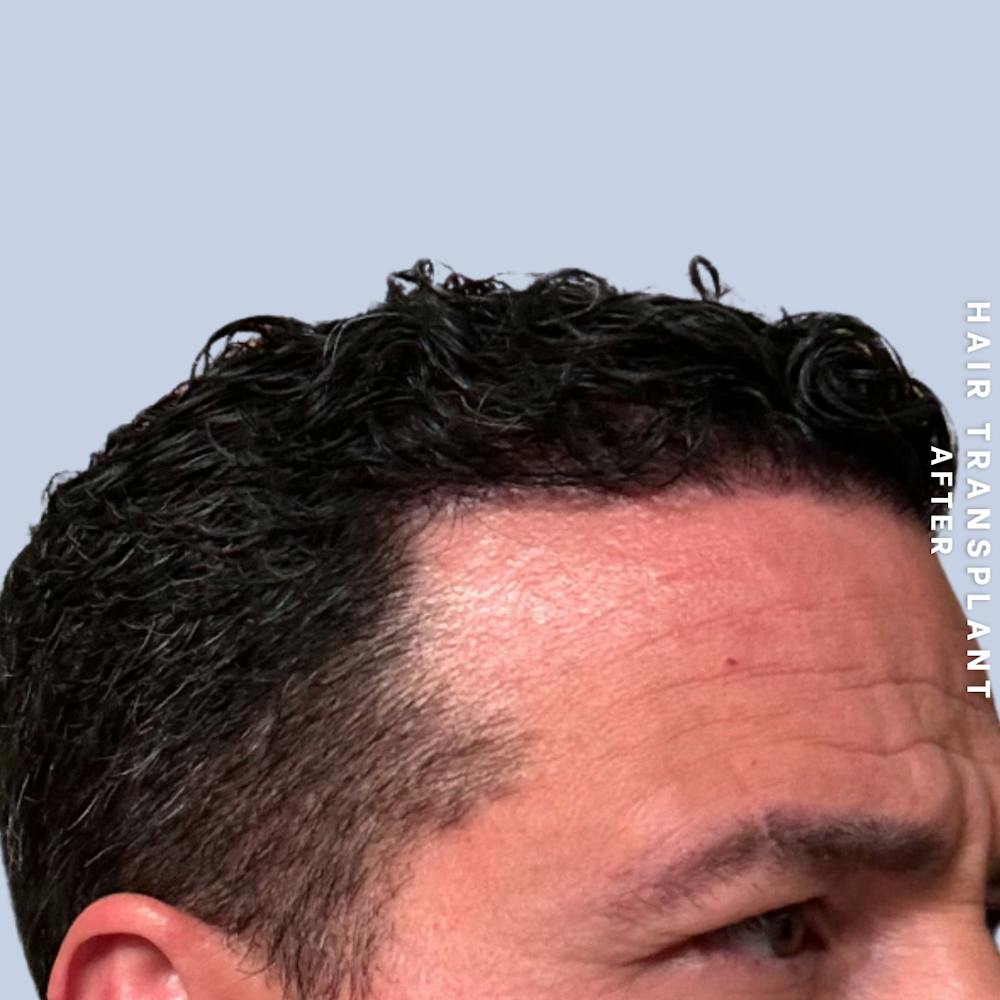 Men's Hair Before & After Gallery - Patient 174166 - Image 2