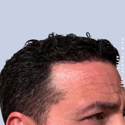 Men's Hair Before & After Gallery - Patient 174166 - Image 2