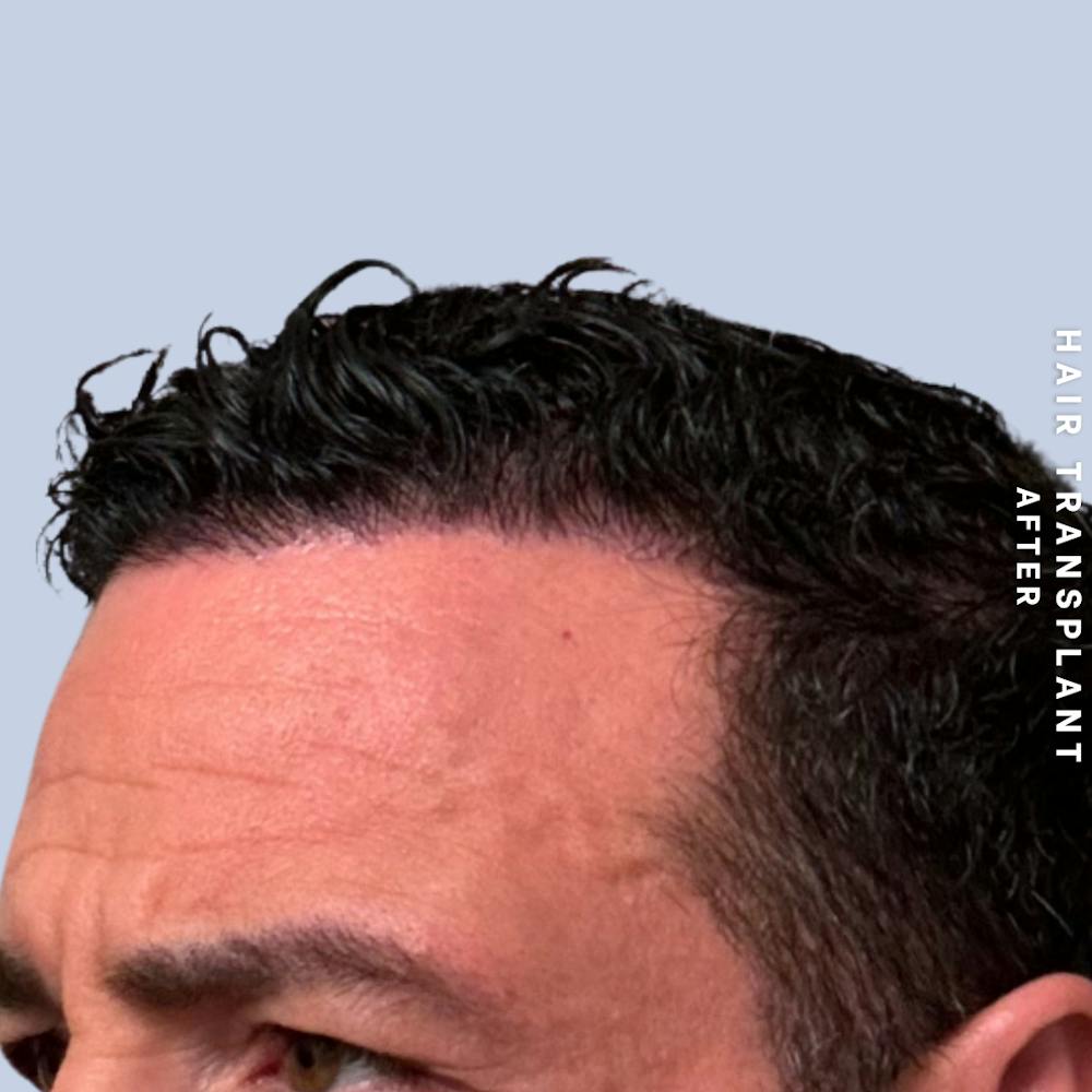 Men's Hair Before & After Gallery - Patient 174166 - Image 6