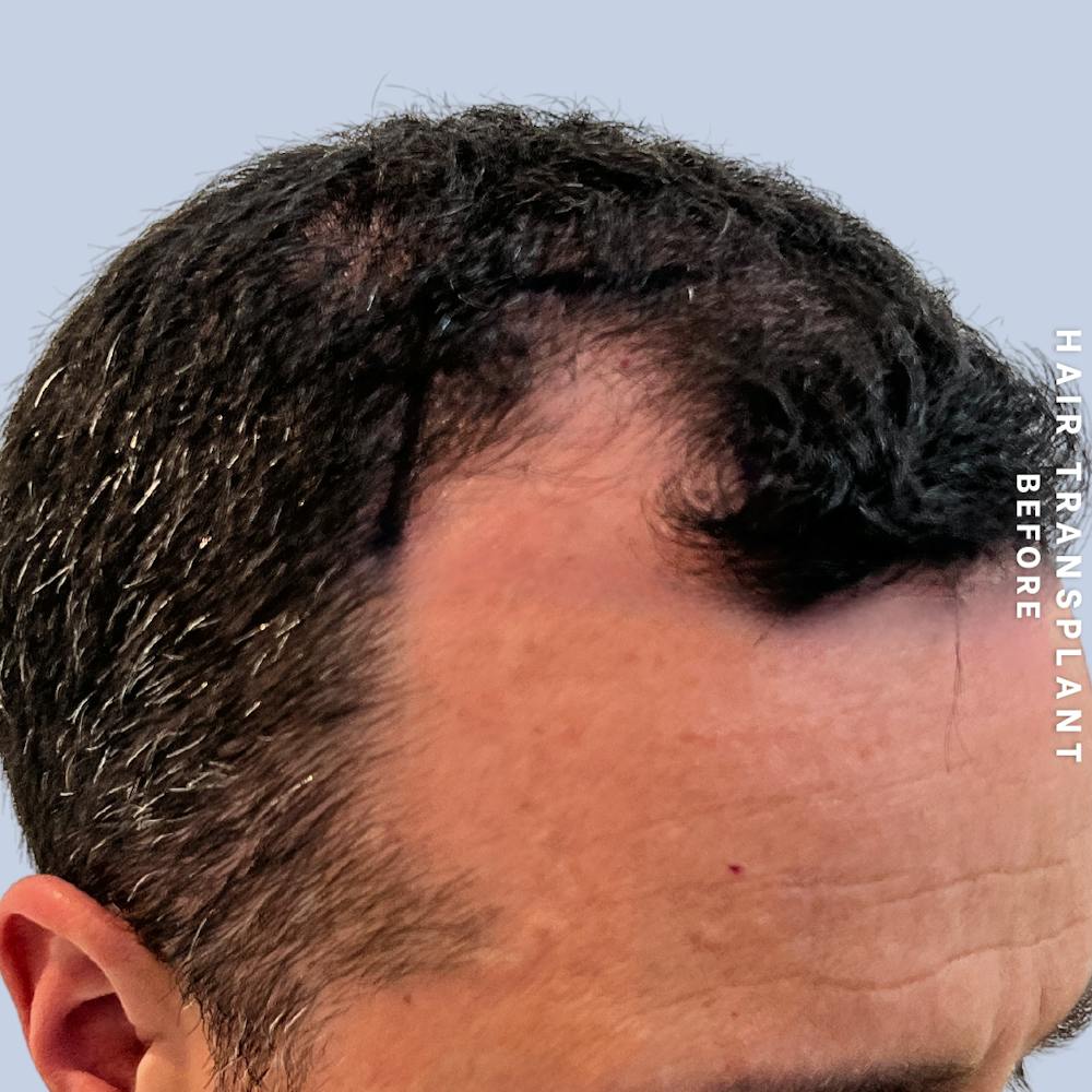 Men's Hair Before & After Gallery - Patient 174166 - Image 1