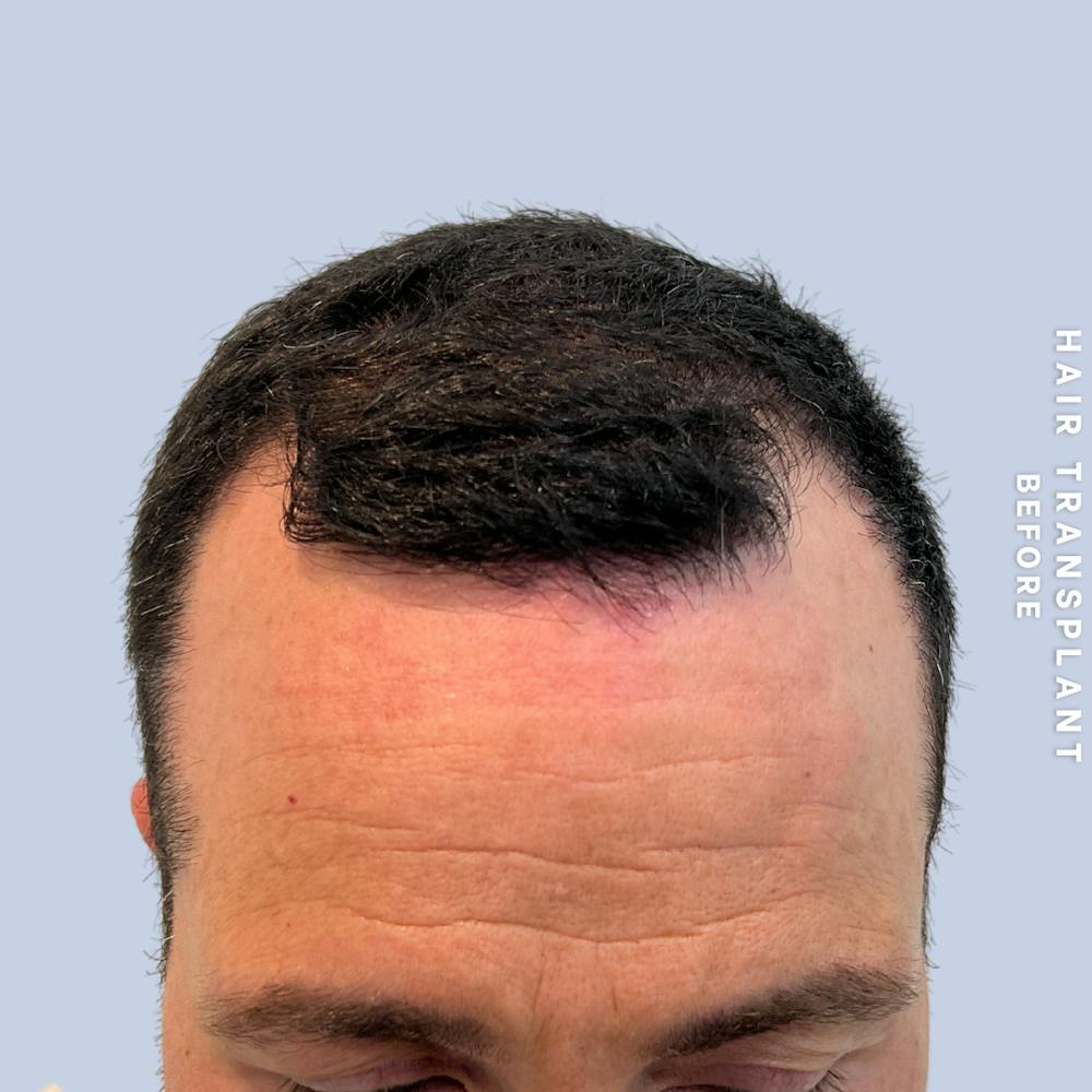 Men's Hair Before & After Gallery - Patient 174166 - Image 3