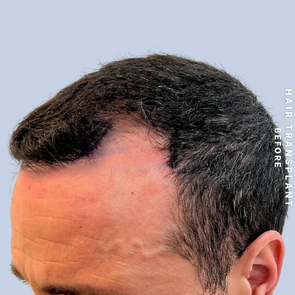 Men's Hair Before & After Gallery - Patient 174166 - Image 5