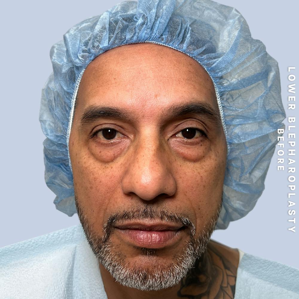 Eyes Before & After Gallery - Patient 696657 - Image 1