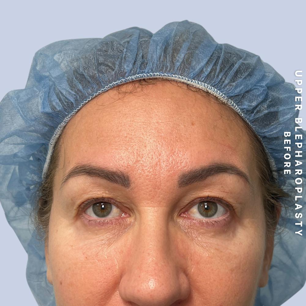 Eyes Before & After Gallery - Patient 165041 - Image 1