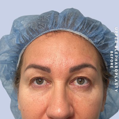 Eyes Before & After Gallery - Patient 165041 - Image 1