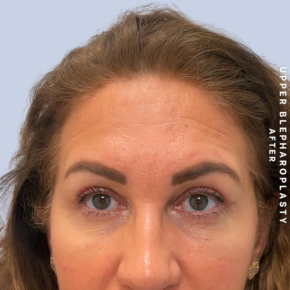 Eyes Before & After Gallery - Patient 165041 - Image 2