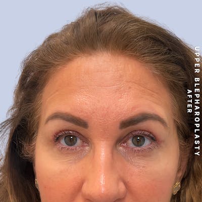 Eyes Before & After Gallery - Patient 165041 - Image 2